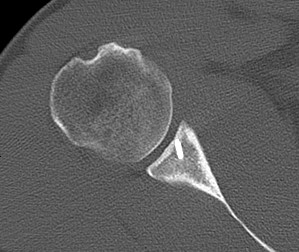 Failed Open Stabilisation CT Axial